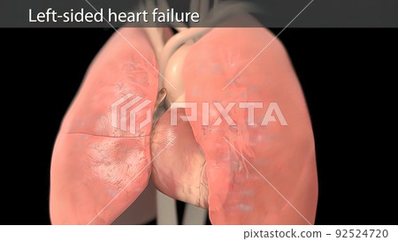 left sided heart failure 3d 92524720