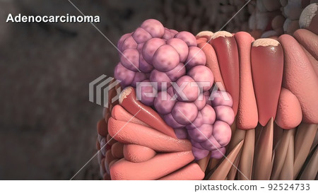 Cancer cell growth illustration. Cancer cell growth illustration. 92524733
