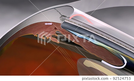 Simulation of development of glaucoma: Simulation of development of glaucoma: 92524753