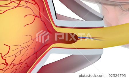 Glaucoma is an eye condition that damages the optic nerve, which is vital for good vision. Glaucoma is an eye condition that damages the optic nerve, which is vital for good vision. 92524793