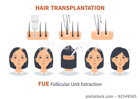 Stages of woman hair transplantation FUE Follicular Unit Extraction Stages of woman hair transplantation FUE Follicular Unit Extraction 92549565
