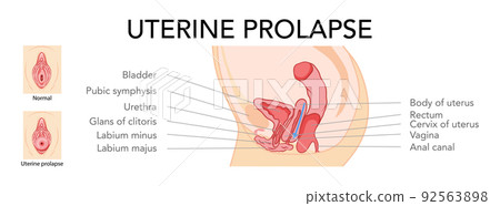 Set of uterine prolapse Female reproductive system uterus labeled in Anatomical infographic. Side view. Human anatomy 92563898