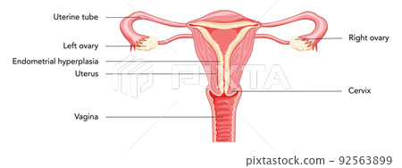 Endometrial hyperplasia Female reproductive system uterus in different styles diagram with inscriptions text Front view 92563899