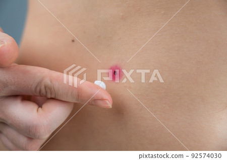 A woman smears cream on a wound after burning a wart. A woman smears cream on a wound after burning a wart. 92574030
