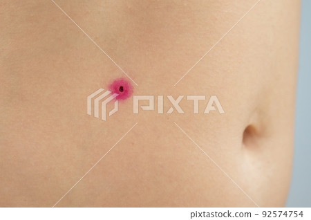 Close-up of a removed wart on a woman's abdomen. Human papillomavirus after burning. 92574754