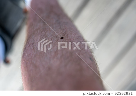 A single male dog tick crawling up leg hair on a Caucasian male. A single male dog tick crawling up leg hair on a Caucasian male. 92592981