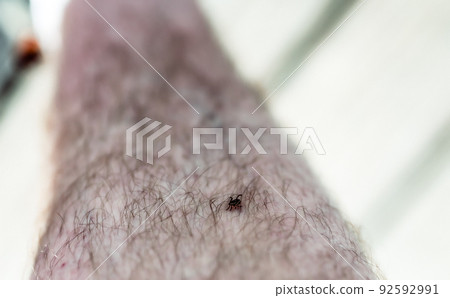 A single male dog tick crawling up leg hair on a Caucasian male. A single male dog tick crawling up leg hair on a Caucasian male. 92592991