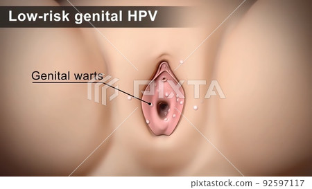 3D of low risk hpv genital warts 92597117