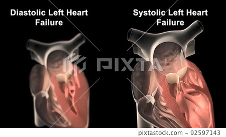 3D Animated right-sided heart failure - beating heart 92597143