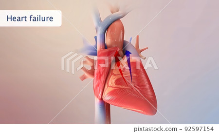 Heart failure means that the heart is unable to pump blood around the body properly. Heart failure means that the heart is unable to pump blood around the body properly. 92597154