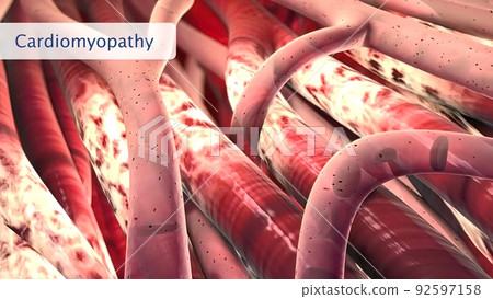 Heart muscle disease in human body Heart muscle disease in human body 92597158