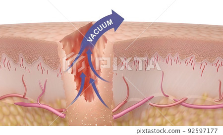 3D Medical illustration of healing time of skin wounds 3D Medical illustration of healing time of skin wounds 92597177