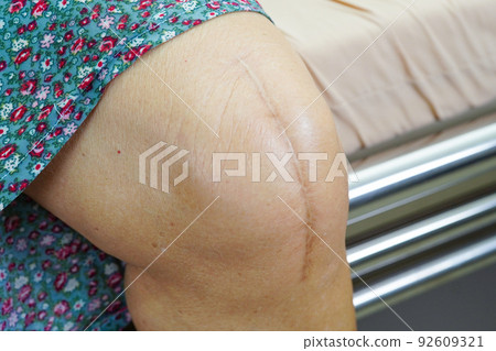 Asian elderly woman patient with scar knee replacement surgery in hospital. Asian elderly woman patient with scar knee replacement surgery in hospital. 92609321
