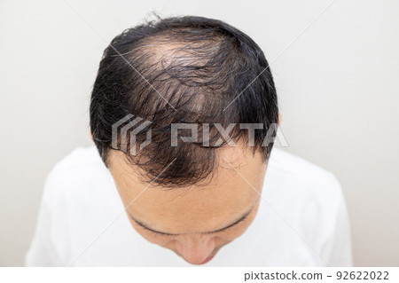 中年男子遭受稀薄的頭髮 92622022
