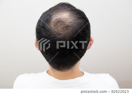 Middle aged man suffering thin hair 92622023