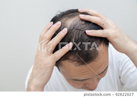 中年男子遭受稀薄的頭髮 92622027