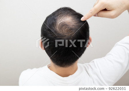 Middle aged man suffering thin hair Middle aged man suffering thin hair 92622031