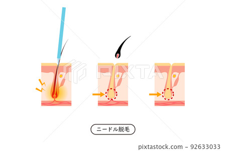 Image of hair removal, flow of hair falling out after needle hair removal Image of hair removal, flow of hair falling out after needle hair removal 92633033