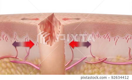 3D Medical illustration of healing time of skin wounds 92634412