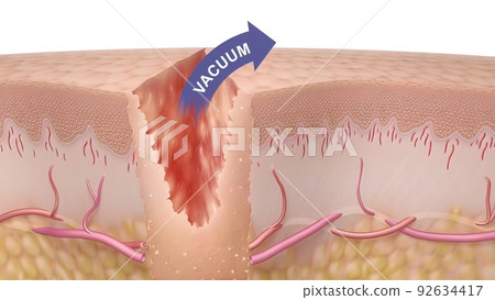 3D Medical illustration of healing time of skin wounds 92634417