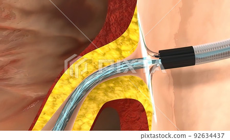 coronary angiography procedures 3d 92634437