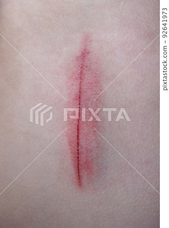 Skin abrasion or scratch on the abdomen. Medical abrasion, injury or wound Skin abrasion or scratch on the abdomen. Medical abrasion, injury or wound 92641973