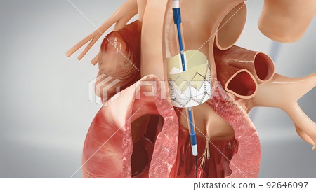 Coronary angioplasty and stent insertion 92646097