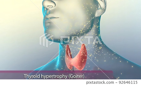 Hyperthyroidism is when the thyroid gland produces more thyroid hormone than your body needs. 92646115