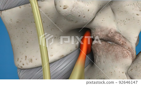 3D illustration of the spinal cord on blue background. Endoscopic lumbar discectomy 92646147
