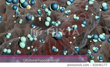 Dilutional hyponatremia, also known as water intoxication 92646177