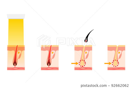 Image of hair removal, flow of hair loss after medical laser hair removal treatment Image of hair removal, flow of hair loss after medical laser hair removal treatment 92662062