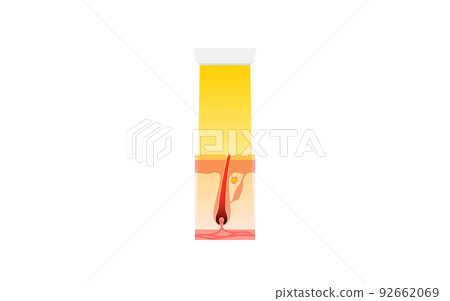 Image of hair removal, flow of hair loss after medical laser hair removal treatment 92662069