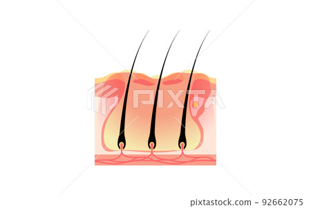 Illustrative illustration of ``you'' in which multiple folliculitis exacerbated folliculitis are connected subcutaneously 92662075