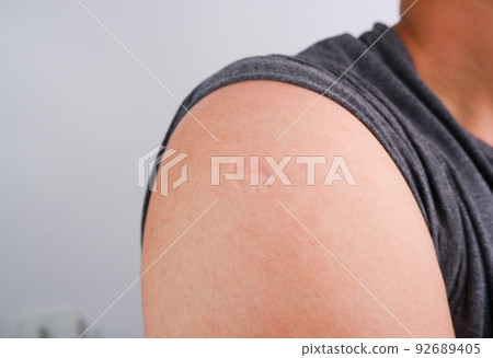 Monkeypox and smallpox vaccine scar on human shoulder of the paitence Monkeypox and smallpox vaccine scar on human shoulder of the paitence 92689405