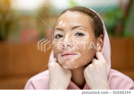 Black african american woman with vitiligo  92698144