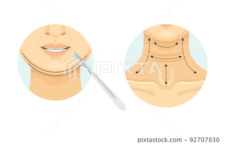 Plastic Surgery for Chin and Neck with Stipple Line as Restoration and Reconstruction of Human Face in Circle Vector Set Plastic Surgery for Chin and Neck with Stipple Line as Restoration and Reconstruction of Human Face in Circle Vector Set 92707830