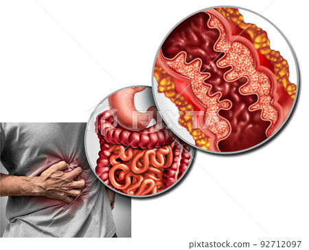 Crohn's disease pain 92712097