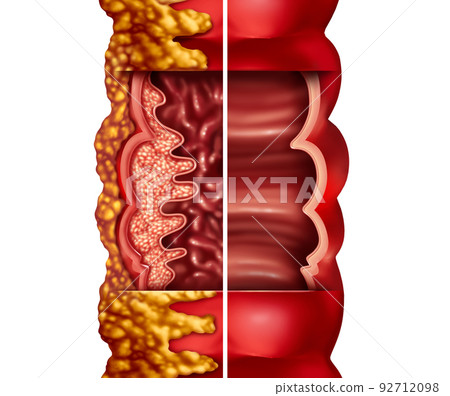 Crohn's Disease Crohn's Disease 92712098