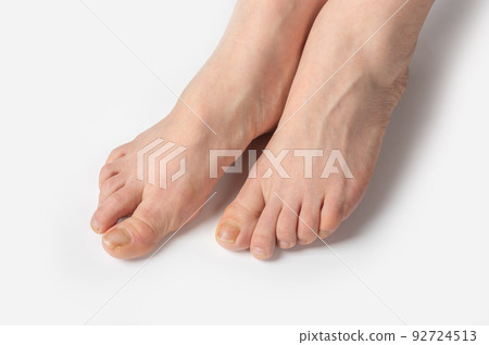 overgrown toenails need a pedicure. white woman feet with nails in need pedicure on white background. spa pedicure salon concept overgrown toenails need a pedicure. white woman feet with nails in need pedicure on white background. spa pedicure salon concept 92724513