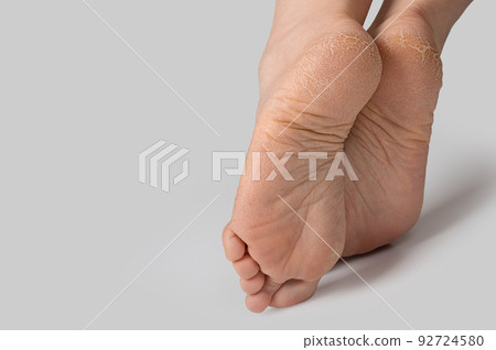 rough skin on female feet on grey background. Dry and cracked soles of feet on white background, womans feet with dry heels, cracked skin. copy space 92724580