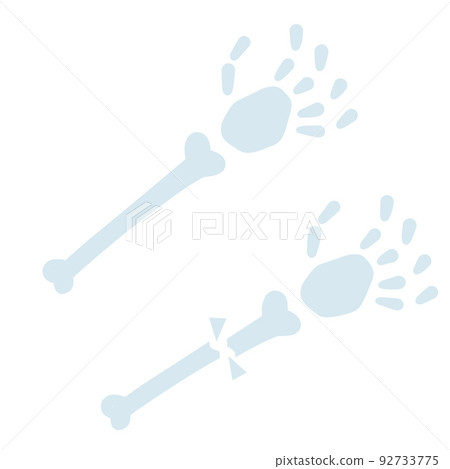 Healthy and sick hand. Broken bone. 92733775