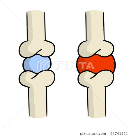 Arthritis. Disease of joints 92741321