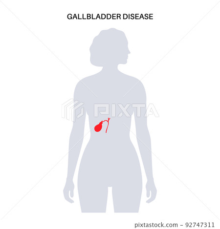 gallbladder disease poster gallbladder disease poster 92747311