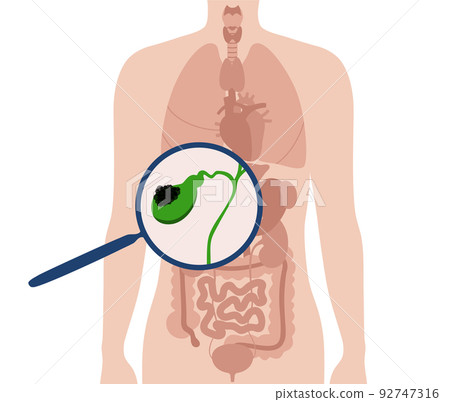gallbladder cancer anatomy gallbladder cancer anatomy 92747316