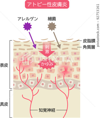 Mechanism of atopic dermatitis Skin cells and cross section 92753161