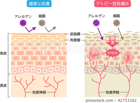 特應性皮炎和健康皮膚比較皮膚細胞和橫截面 92753162