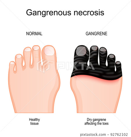 Gangrene affecting the toes.. tissue death by Gangrenous necrosis Gangrene affecting the toes.. tissue death by Gangrenous necrosis 92762102