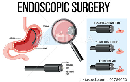 Diagram showing endoscopic surgery 92784650