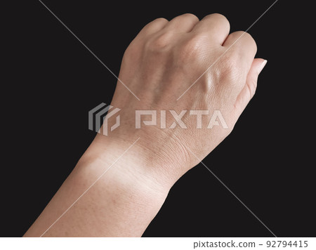 看燒傷的手臂 92794415