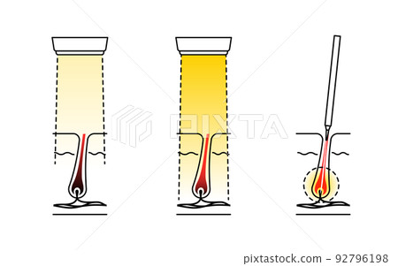 Image of hair removal, esthetic hair removal, medical laser hair removal, needle hair removal Image of hair removal, esthetic hair removal, medical laser hair removal, needle hair removal 92796198